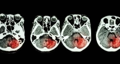 stroke