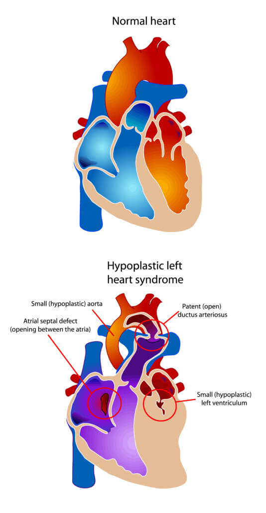 гипоплазия левой половины сердца
