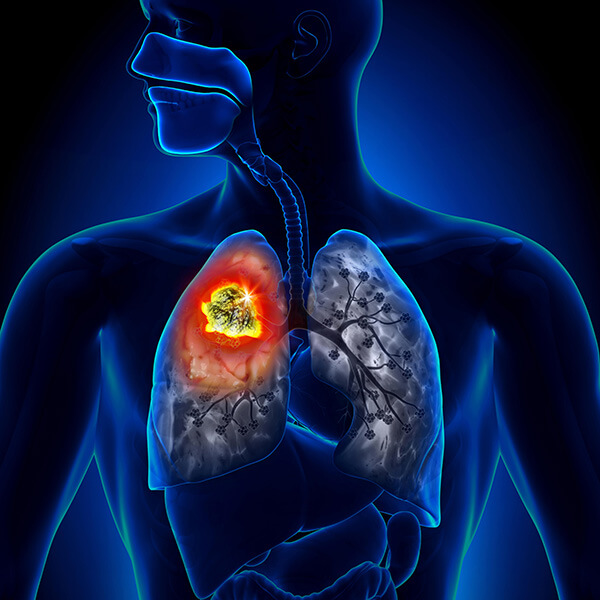 Новинка в Шибе: раннее выявление рака легких с дозой радиации меньше на 96%